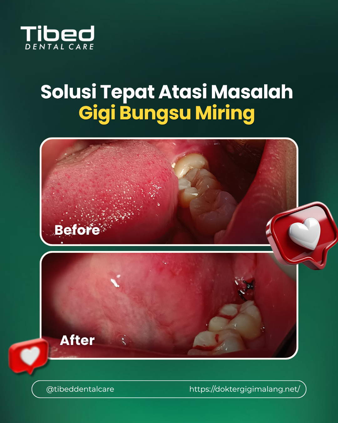 Foto Before After Pencabutan Gigi Bungsu Odontektomi Tibed Dental Care Dokter Gigi Malang