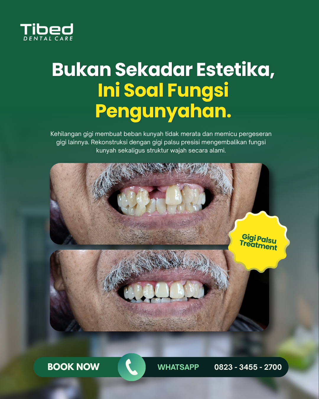 pemakaian gigi palsu dokter gigi malang terdekat