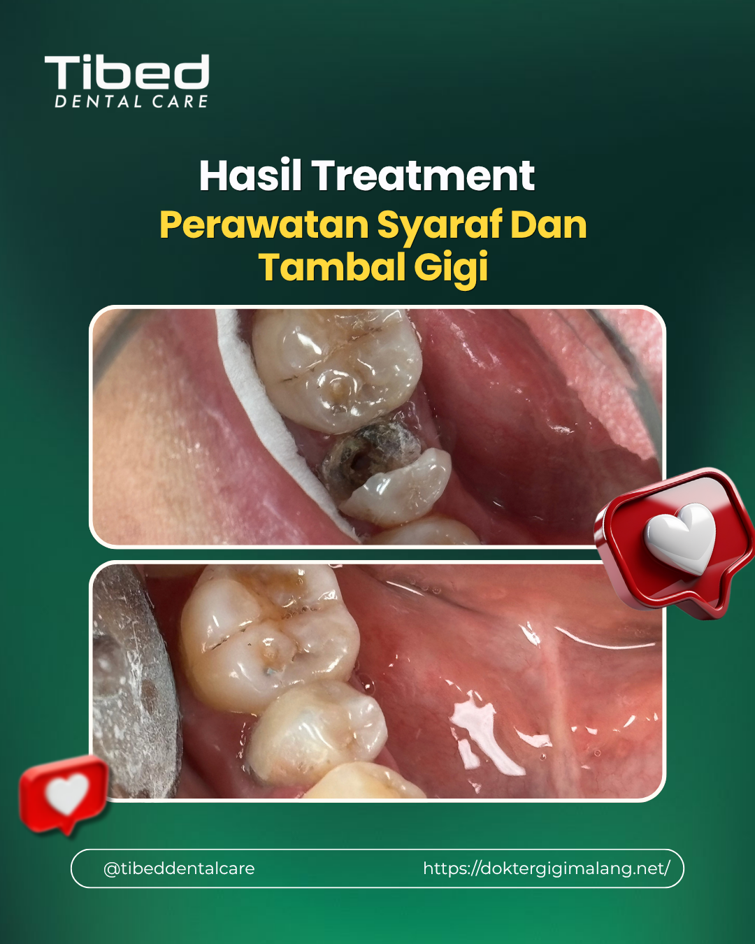 Perawatan saluran akar gigi malang tibed dental care